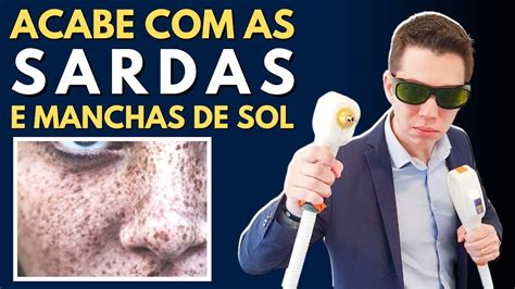 Acabe As Sardas E Manchas Do Sol Tratamentos Para Se Livrar Das