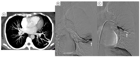 Scielo Brasil Update On Pulmonary Arteriovenous Malformations