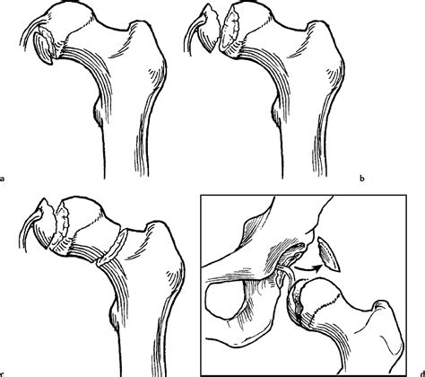 Hip Dislocations And Associated Fractures Of The Femoral Head Musculoskeletal Key