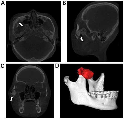 Coronoid Process Radiograph