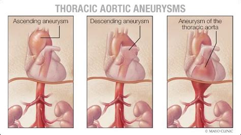 Ascending Thoracic Aortic Aneurysm