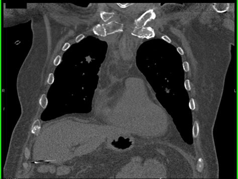 Osteomyelitis Sternum With Abscess Musculoskeletal Case Studies