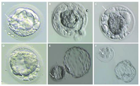 Different Degrees Of Fragmentation In Cleavage Stage Human Embryos Download Scientific Diagram