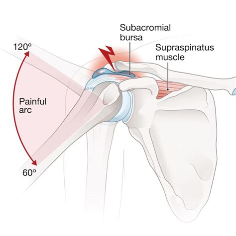 Shoulder Impingement - Los Angeles, CA - Dr. Jason Snibbe