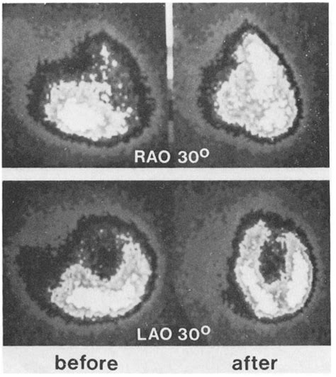 Figure From Use Of Dual Intracoronary Scintigraphy With Thallium