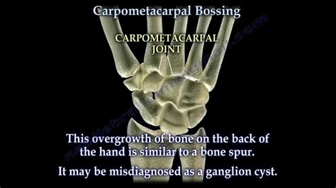 Carpometacarpal Bossing Everything You Need To Know Dr Nabil