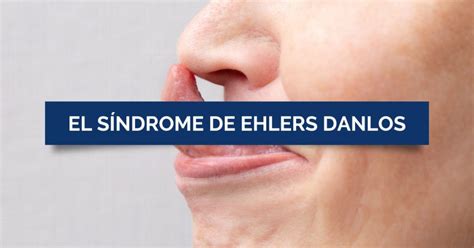 El Síndrome de Ehlers Danlos Dr Ricardo Gil