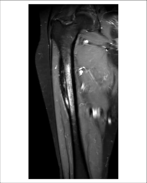 Right femur MRI shows lateral cortical thickening of the proximal femur... | Download Scientific ...