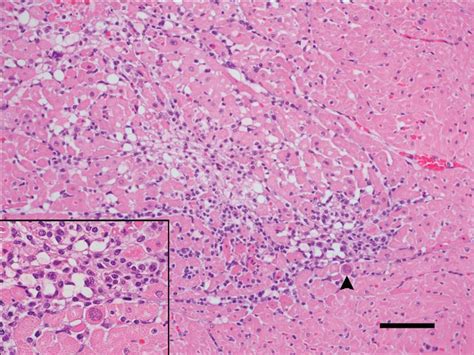 Toxoplasmosis Brain Histology