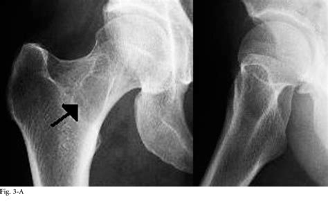 Large Femoral Neck Cysts In Association With Femoroacetabular