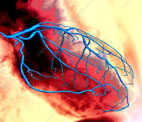coronary artery stock image p science photo library