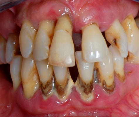 PERIODONTITIS Agresiva Diagnóstico y tratamiento Directorio