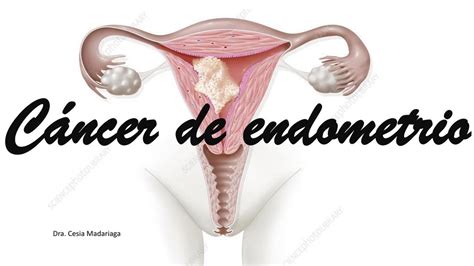 Cancer De Endometrio E Hiperplasia Endometrial Dani Gutierrez UDocz