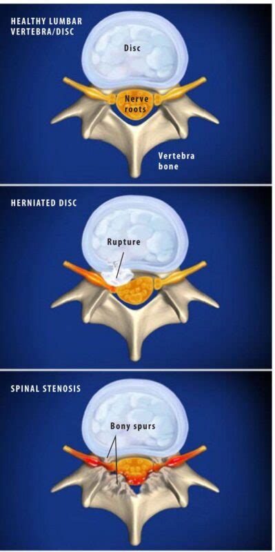 Lumbar Radiculopathy Treatment In Plano Advanced Spine Center