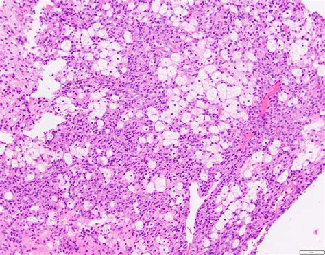 Pathology Outlines Solid Pseudopapillary Neoplasm