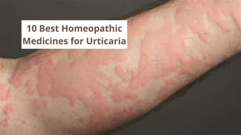 Best Homeopathic Medicine For Urticaria