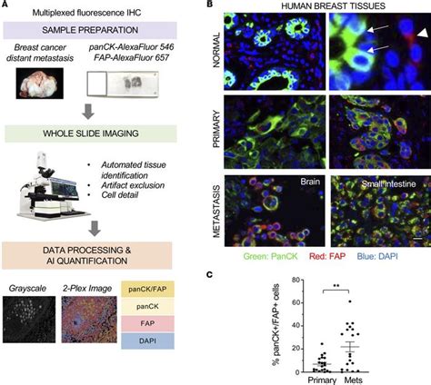 Jci Insight A Hybrid Breast Cancer Mesenchymal Stem Cell Population