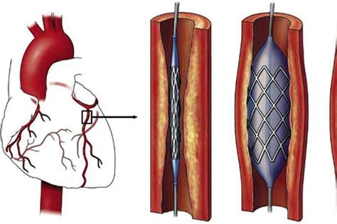 Common types of coronary stents used in Vietnam | Vinmec