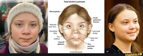 Fetal Alcohol Syndrome Track Ears Epicanthal Folds Flat Midfece Small