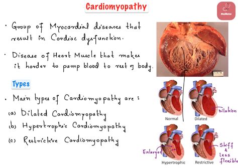 SOLUTION Cardiomyopathy Studypool