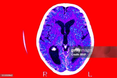 70 Ct Of Alzheimers Disease Stock Photos High Res Pictures And Images