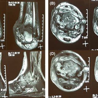 (A) coronal T1‐weighted, (B) axial T2‐weighted, (C) sagittal Short Tau ... 