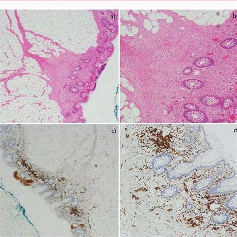 Colonoscopy Showing Sub Pedunculated Polyp In Splenic Flexure