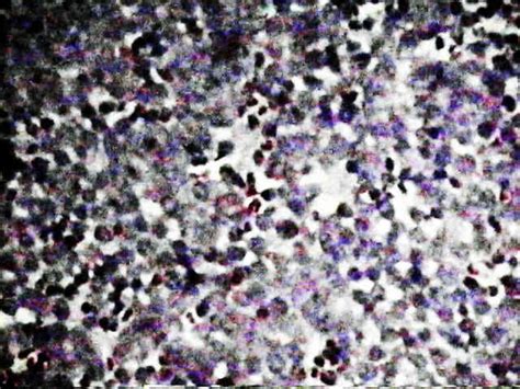 Histology of Ewing's Sarcoma : Wheeless' Textbook of Orthopaedics