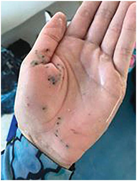 Sea Urchin Injury A Year Old Female With Sea Urchin Spine Injury Of