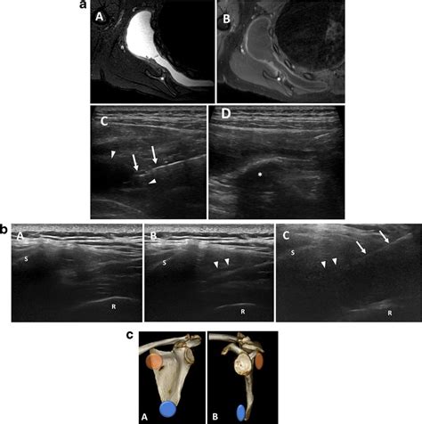 A Scapulothoracic Bursitis Findings Axial T2 Fat Saturated A And T1