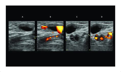 Chronic Post Thrombotic Changes A B Mode Image Showing No Dilation