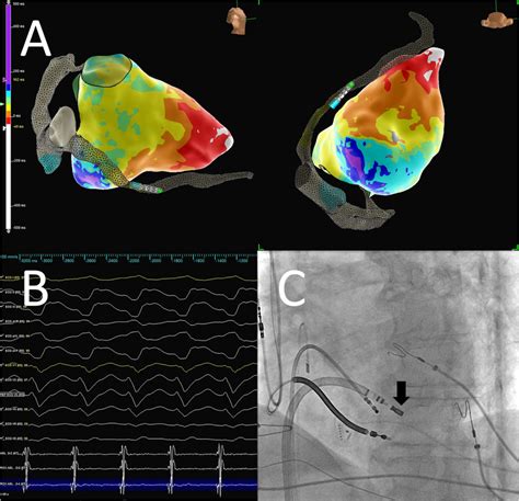 Panel A D Electroanatomic Map Demonstrating Cannulation Of The