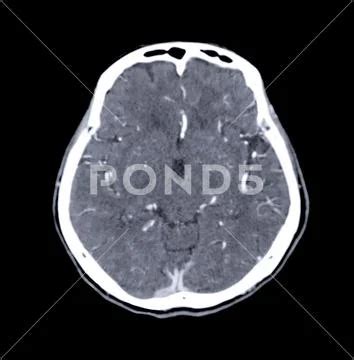 Ct Scan Of The Brain Axial Plane For Diagnosis Brain Tumor Stroke