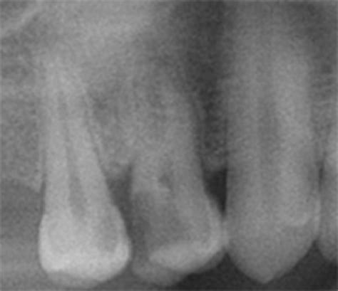 Periapical Radiograph Showing The Complex Root Morphology Of The