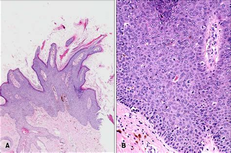 Figure 2 From A Case Of Isolated Bowenoid Papulosis Of The Nipple