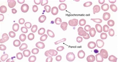 Pathology Flashcards | Quizlet