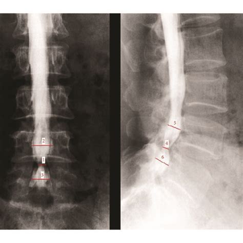 Measurement Of Stenosis Ratio Sr At L4 5 Level Line 1 [ Line 2