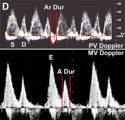 Pedi Cardiology Echo Mitral Inflow Doppler