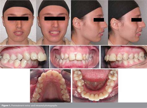 Table 1 From Patient With Severe Skeletal Class II Malocclusion Double