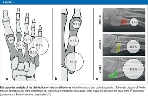 Pseudo Jones Fracture