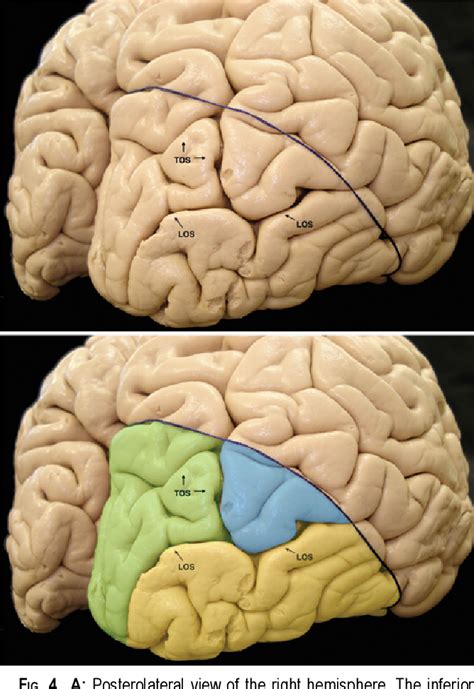 Figure 4 From The Occipital Lobe Convexity Sulci And Gyri Laboratory