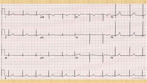 Lecture 2 Why Do Ecgs Look Like They Do Part Ppt Download