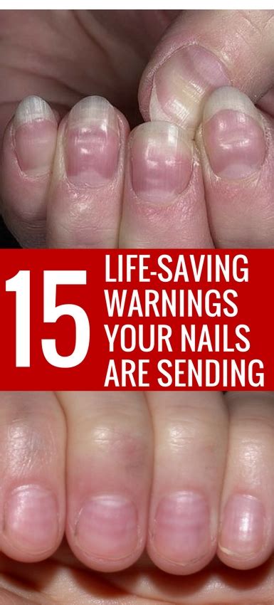 15 Health Warnings Your Fingernails May Be Sending