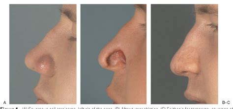 Figure 1 From One Stage Reconstruction Of Nasal Defects Evaluation Of