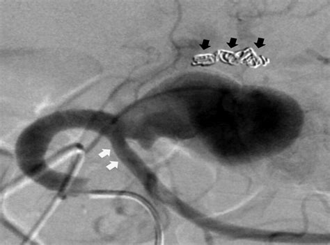 Endovascular Exclusion Of A Splenic Artery Aneurysm Using A Pipeline Embolization Device