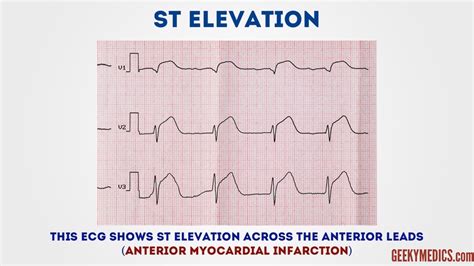 How To Read An Ecg Ecg Interpretation Geeky Medics