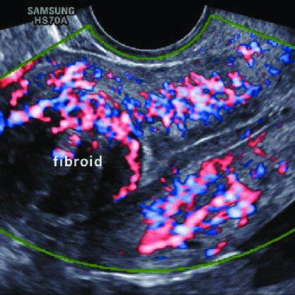 Transvaginal Ultrasound Image In A Longitudinal View Showing A