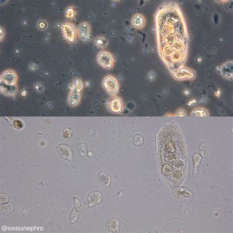 Transitional Renal Epithelial Cells In Urine