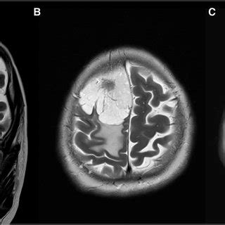 Pre Surgical MRI In A T2 Coronal A T2 Axial B And T1 Axial View