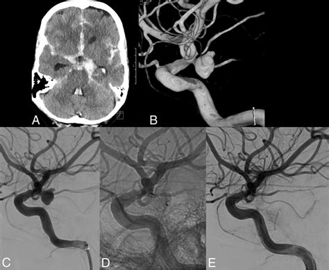 A Year Old Woman With A Ruptured Small Neck Posterior Communicating